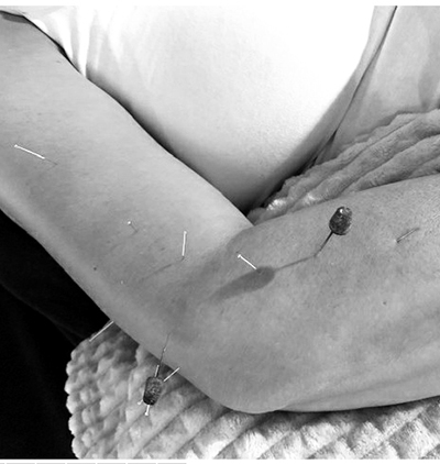 Schlie2022 Akupunktur