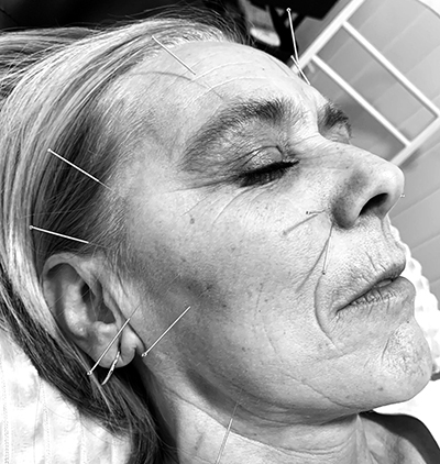 Schlie2022 Akupunktør