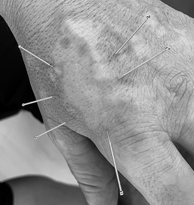 Schlie2022 Akupunktur