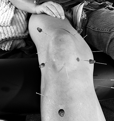 Schlie2022 Akupunktur